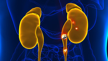 Piedras en el riñón: a quién afecta, prevención, síntomas y tratamiento
